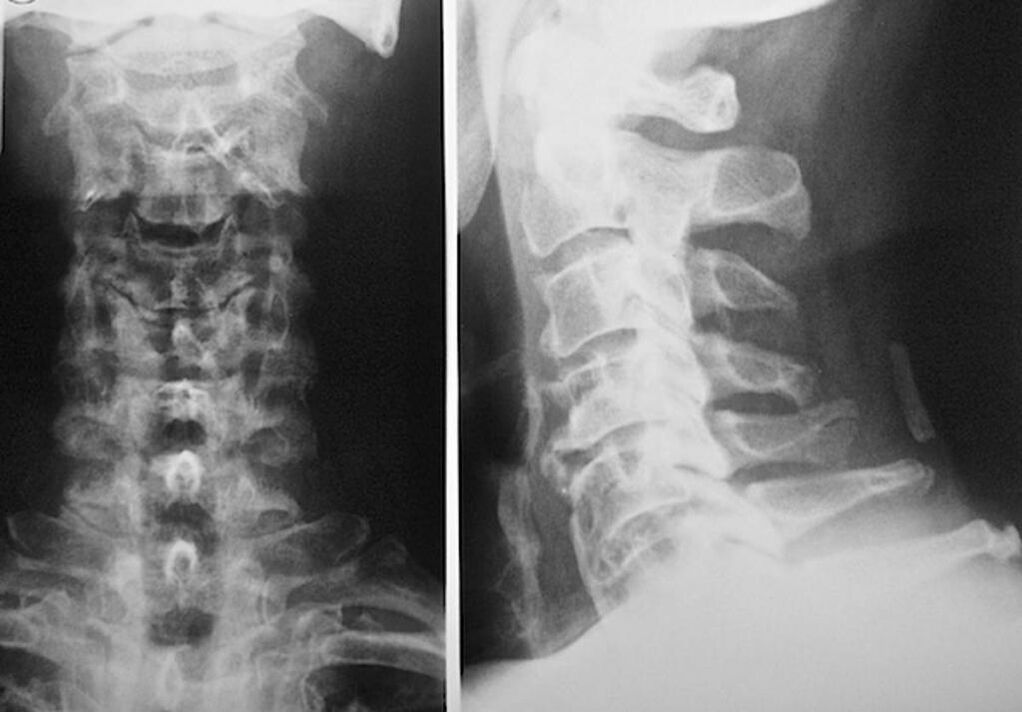 radiografia del rachide cervicale con osteocondrosi