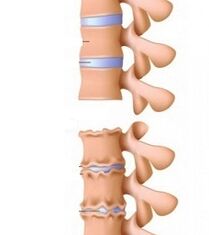 Fase delle rampe di osteocondosi del collo