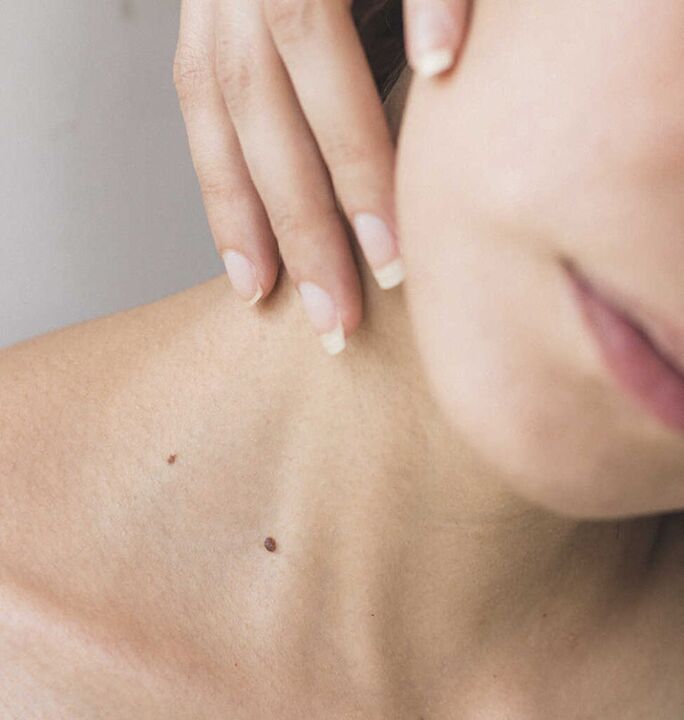 La rigidità del collo è uno dei sintomi dello stadio iniziale dell'osteocondrosi del rachide cervicale