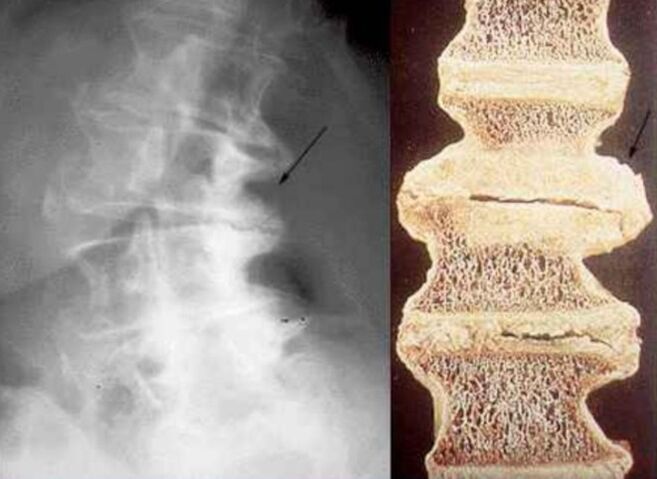 danno alle vertebre nell'osteocondrosi toracica