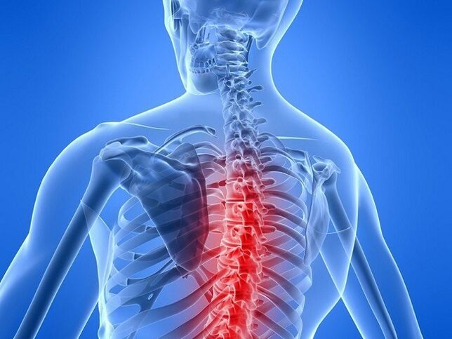 osteocondrosi della colonna vertebrale toracica