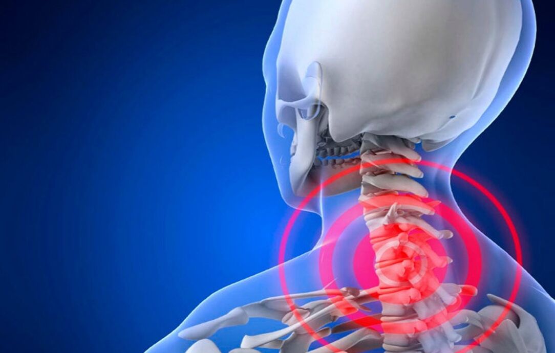 osteocondrosi del rachide cervicale